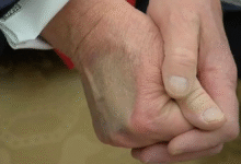Makeup Artist Calls White House ‘Sloppy’ for Trying to Cover Up Trump’s Hand Bruises