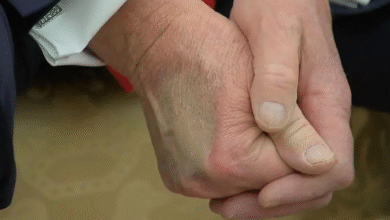Makeup Artist Calls White House ‘Sloppy’ for Trying to Cover Up Trump’s Hand Bruises