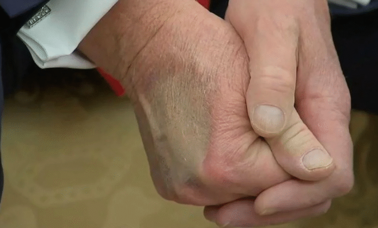 Makeup Artist Calls White House ‘Sloppy’ for Trying to Cover Up Trump’s Hand Bruises